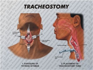 Tracheostomy Diagram