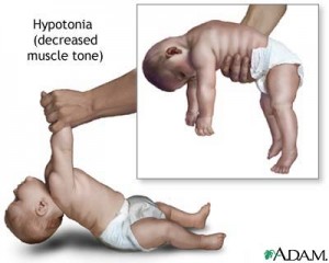 Baby with Hypotonia