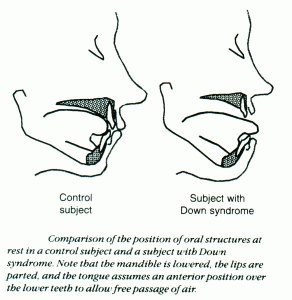 Oral Structure Diagram for Down Syndrome