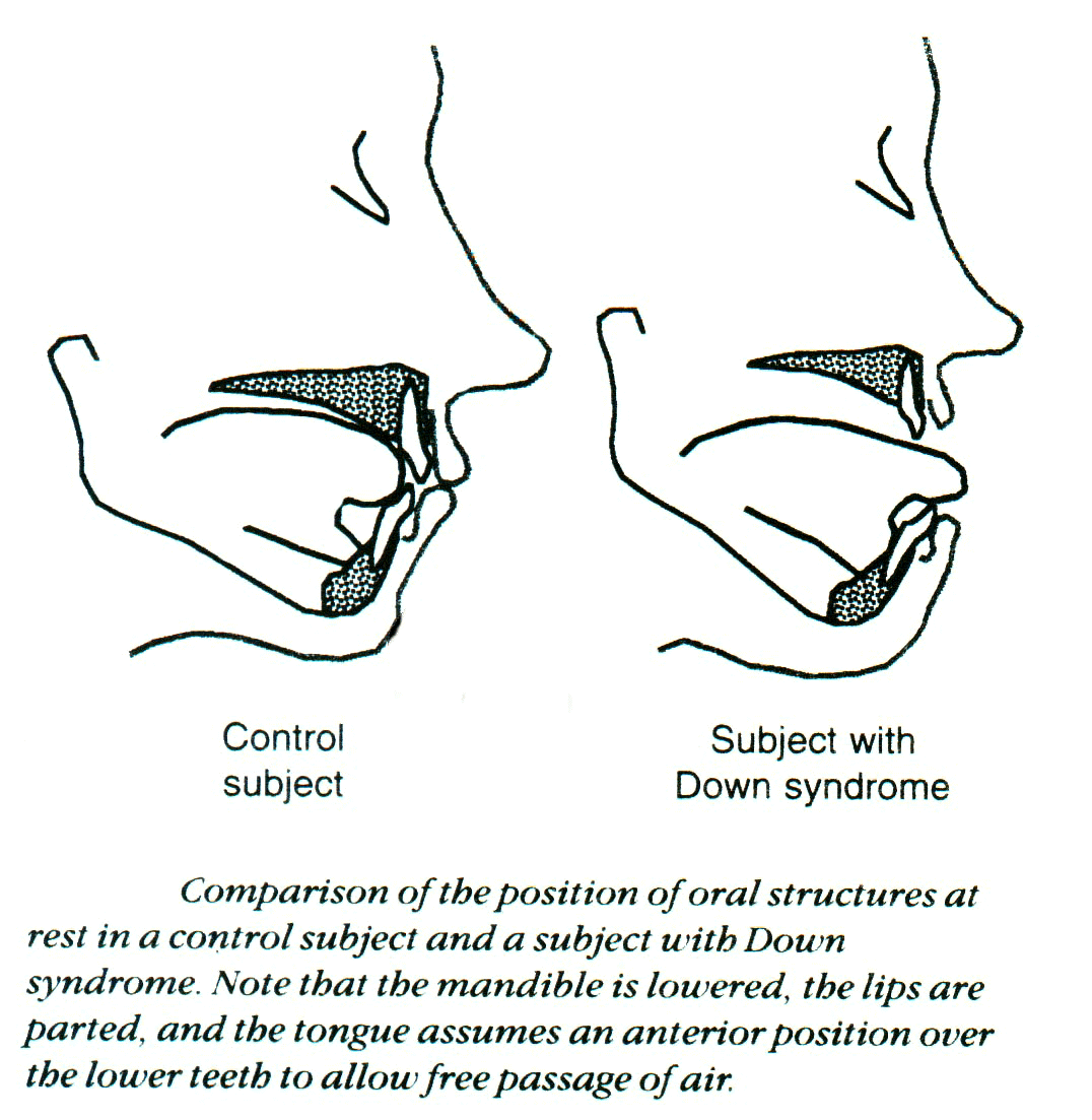 Speech Difficulties In Down Syndrome