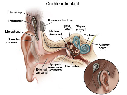 Cochlear Implant Diagram