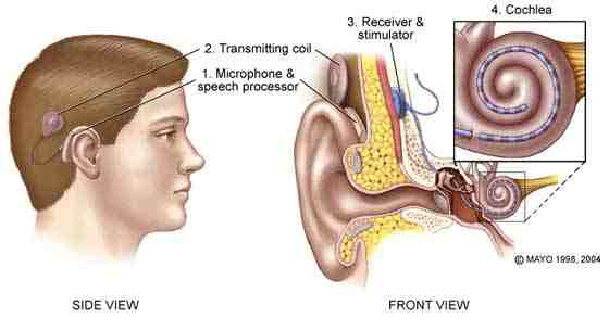 Cochlear Implant Diagram