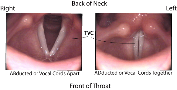 Paradoxical Vocal Fold Movement Diagram