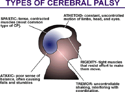 Cerebral Palsy Of Ma