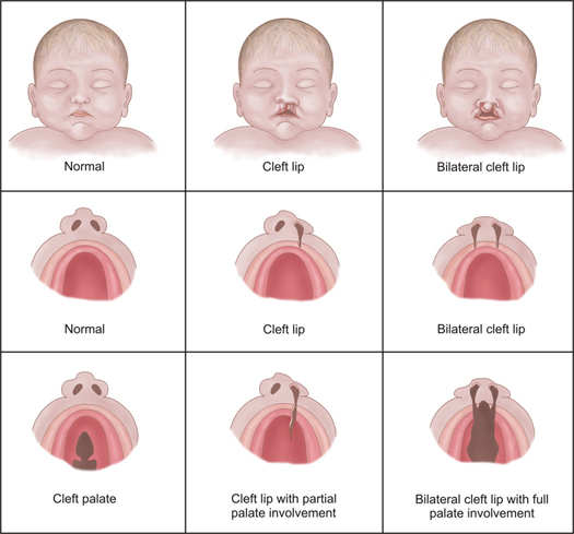 cleft palate types