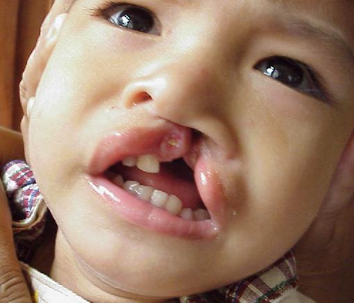 child with cleft