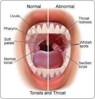 Enlarged Tonsils Image Courtesy of medimiss.net