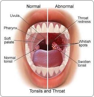 cervical most cancers symptoms and symptoms