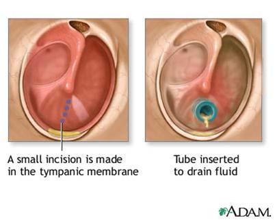 Ear tubes in children help drain fluid