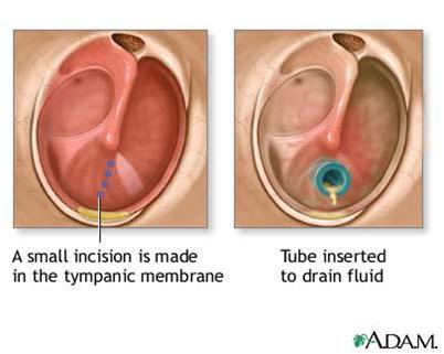 Can Constant Ear Infections Cause Speech Delay In Children?