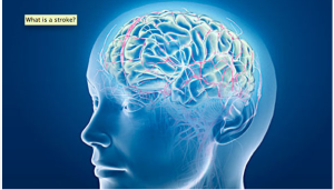 Effect of Stroke on Speech and Language