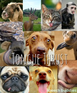 Tongue Thrust Treatment