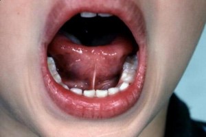 Bambino con una linguetta