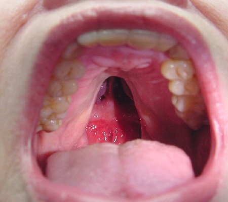 A patient with a cleft palate, which is a split in the roof of the mouth. A cleft palate often leads to issues in breathing, drinking, eating and speaking. Even after reparative surgery, the patient will likely need speech therapy in the long-term. Credit: Udent.com via www.speechbuddy.com